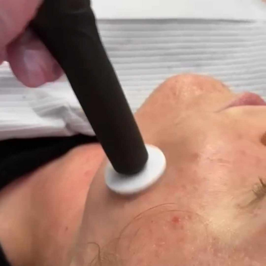 VIRTUAL Microneedling: PRP Facial & Hair Restoration