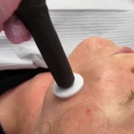 HANDS ON Microneedling: PRP FACIAL & HAIR RESTORATION